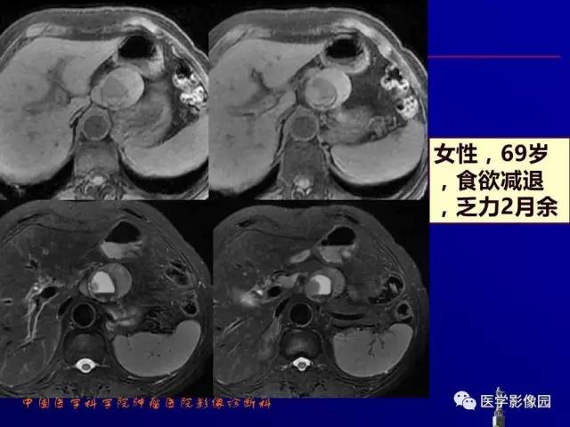 【PPT】胰腺及胆道肿瘤的CT、MRI诊断思路