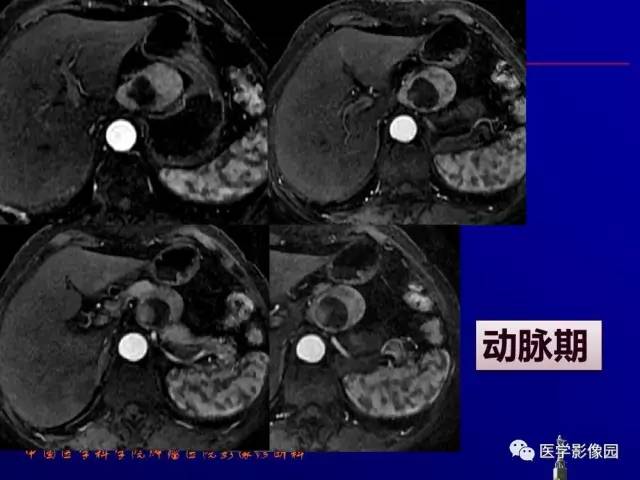【PPT】胰腺及胆道肿瘤的CT、MRI诊断思路