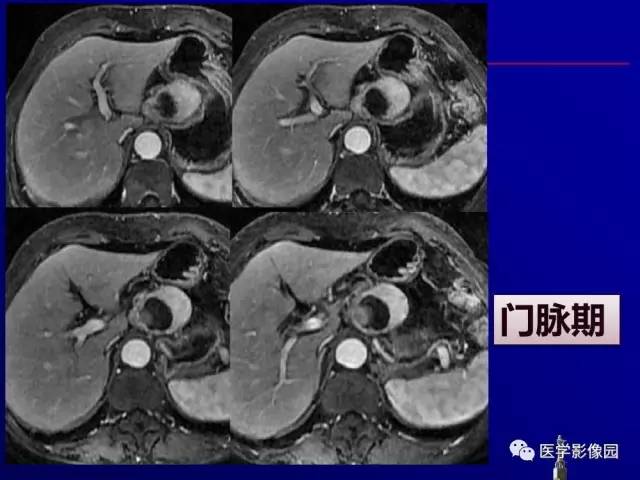 【PPT】胰腺及胆道肿瘤的CT、MRI诊断思路