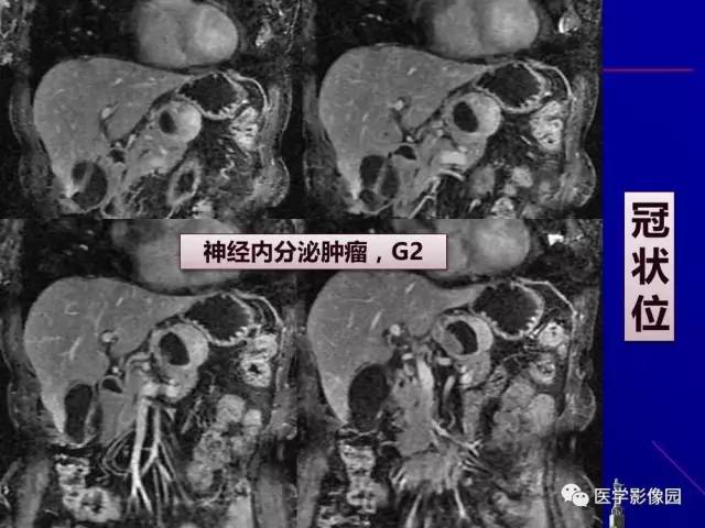 【PPT】胰腺及胆道肿瘤的CT、MRI诊断思路