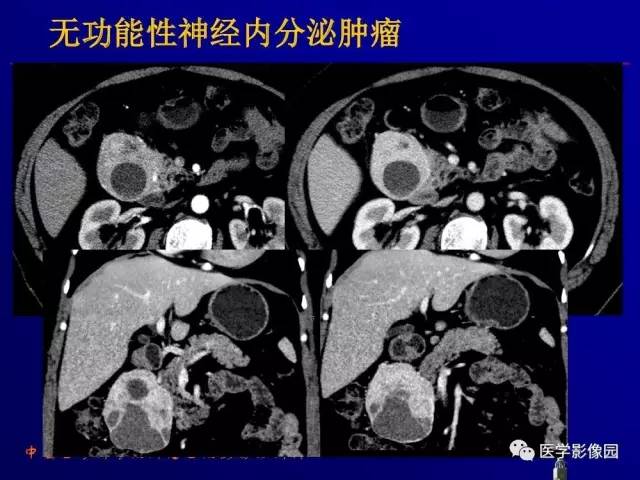 【PPT】胰腺及胆道肿瘤的CT、MRI诊断思路