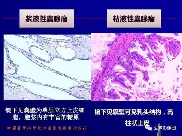 【PPT】胰腺及胆道肿瘤的CT、MRI诊断思路