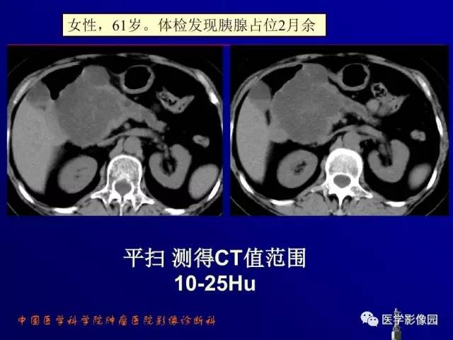 【PPT】胰腺及胆道肿瘤的CT、MRI诊断思路