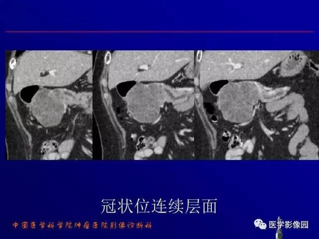 【PPT】胰腺及胆道肿瘤的CT、MRI诊断思路