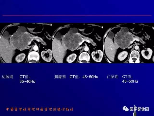 【PPT】胰腺及胆道肿瘤的CT、MRI诊断思路
