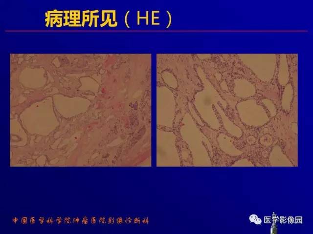 【PPT】胰腺及胆道肿瘤的CT、MRI诊断思路