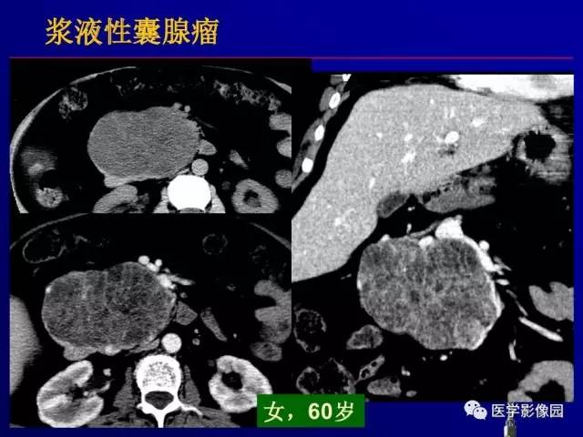【PPT】胰腺及胆道肿瘤的CT、MRI诊断思路