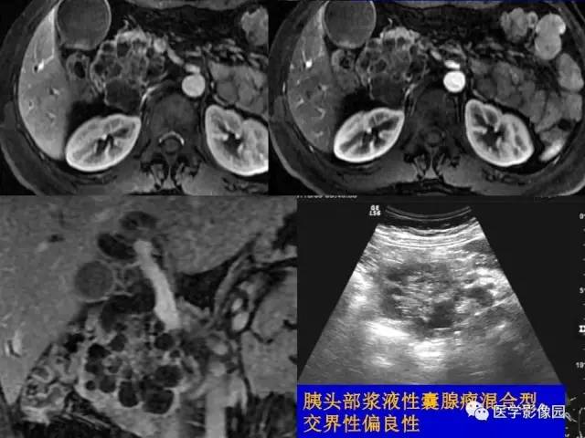 【PPT】胰腺及胆道肿瘤的CT、MRI诊断思路