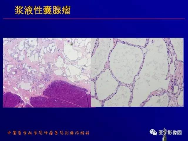 【PPT】胰腺及胆道肿瘤的CT、MRI诊断思路