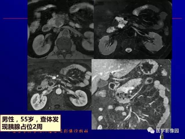 【PPT】胰腺及胆道肿瘤的CT、MRI诊断思路