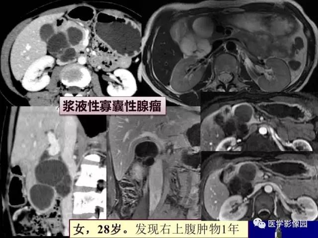 【PPT】胰腺及胆道肿瘤的CT、MRI诊断思路