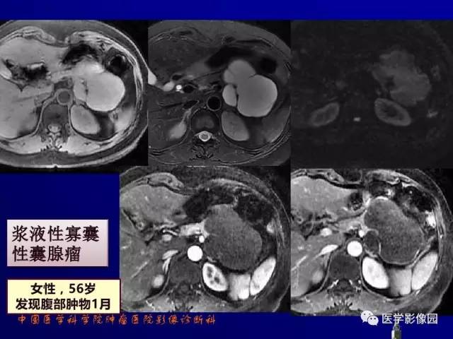 【PPT】胰腺及胆道肿瘤的CT、MRI诊断思路
