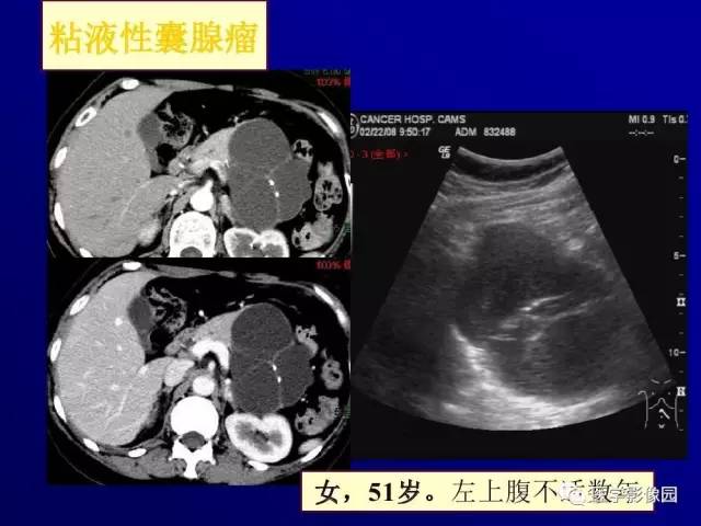 【PPT】胰腺及胆道肿瘤的CT、MRI诊断思路