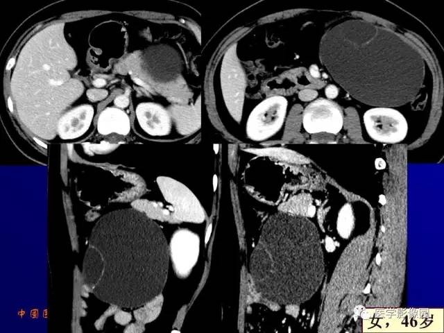 【PPT】胰腺及胆道肿瘤的CT、MRI诊断思路