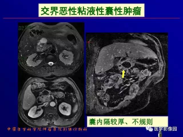 【PPT】胰腺及胆道肿瘤的CT、MRI诊断思路