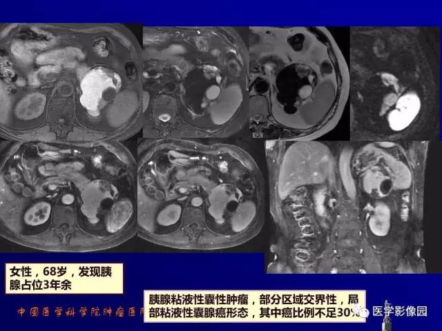 【PPT】胰腺及胆道肿瘤的CT、MRI诊断思路