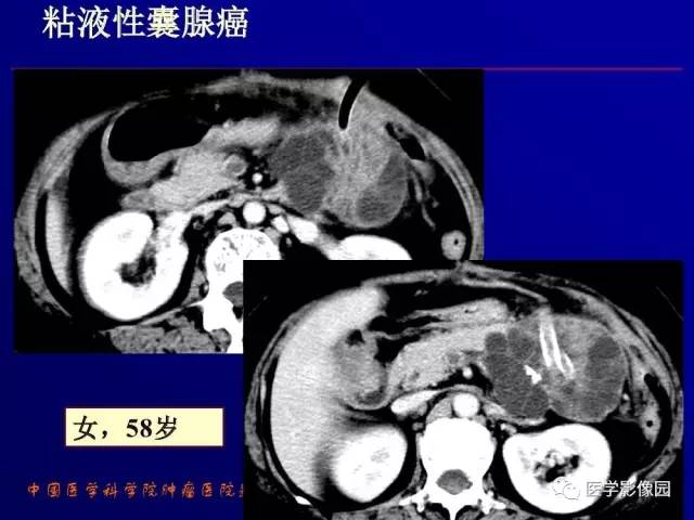 【PPT】胰腺及胆道肿瘤的CT、MRI诊断思路