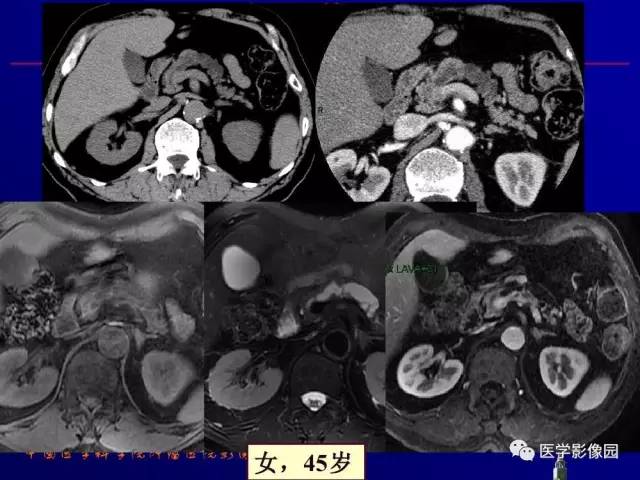 【PPT】胰腺及胆道肿瘤的CT、MRI诊断思路