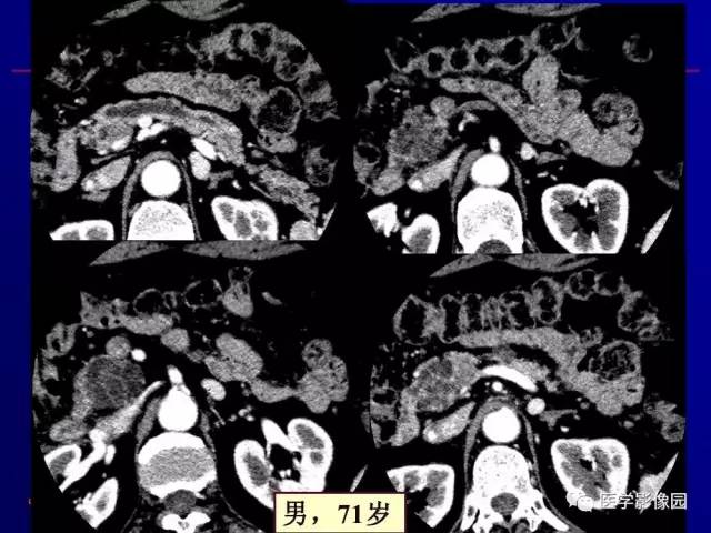【PPT】胰腺及胆道肿瘤的CT、MRI诊断思路