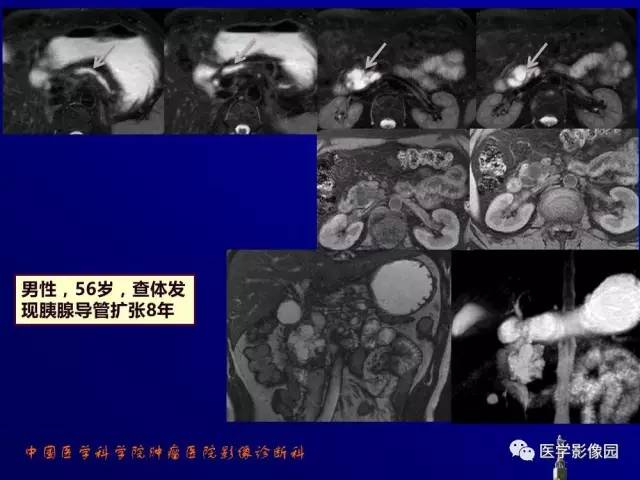 【PPT】胰腺及胆道肿瘤的CT、MRI诊断思路