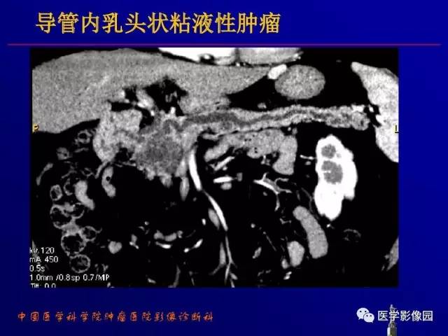 【PPT】胰腺及胆道肿瘤的CT、MRI诊断思路