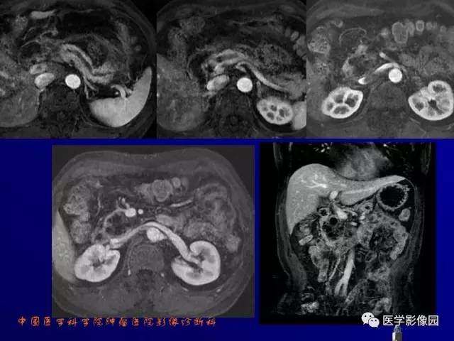【PPT】胰腺及胆道肿瘤的CT、MRI诊断思路