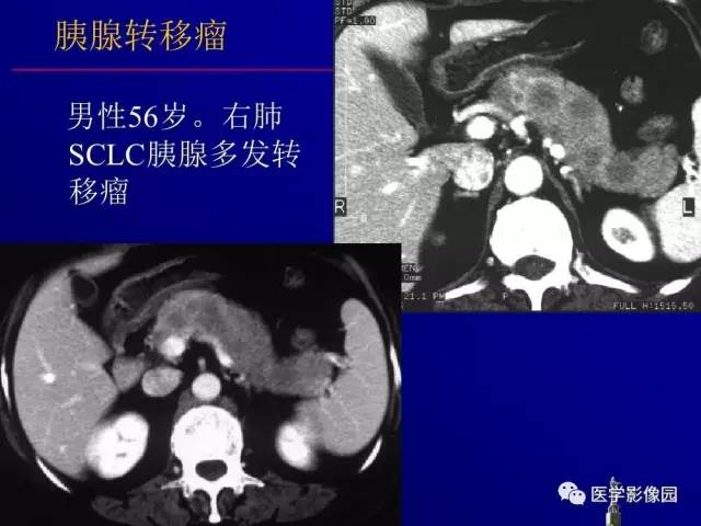 【PPT】胰腺及胆道肿瘤的CT、MRI诊断思路