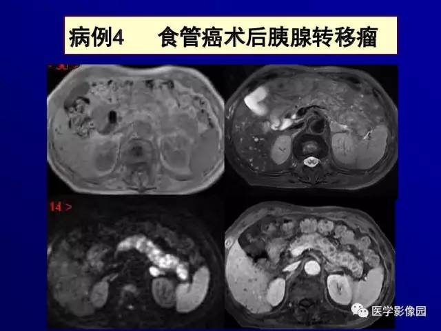 【PPT】胰腺及胆道肿瘤的CT、MRI诊断思路