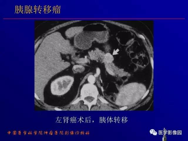 【PPT】胰腺及胆道肿瘤的CT、MRI诊断思路
