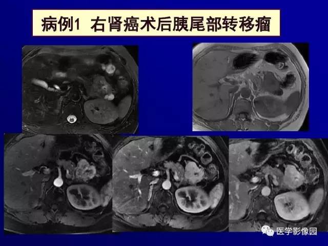 【PPT】胰腺及胆道肿瘤的CT、MRI诊断思路