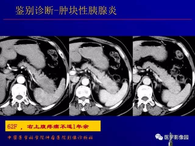 【PPT】胰腺及胆道肿瘤的CT、MRI诊断思路