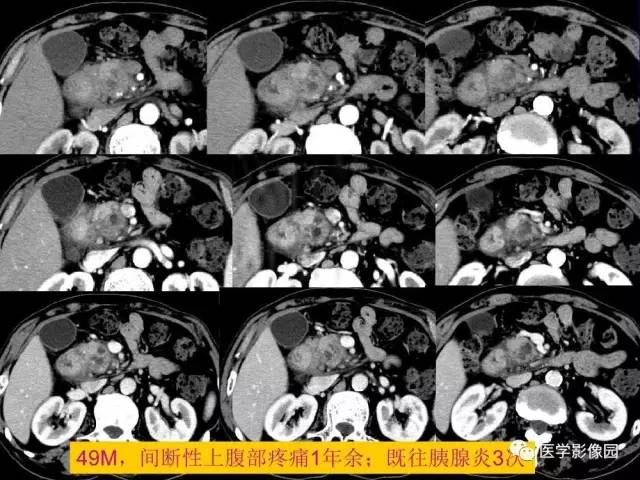 【PPT】胰腺及胆道肿瘤的CT、MRI诊断思路