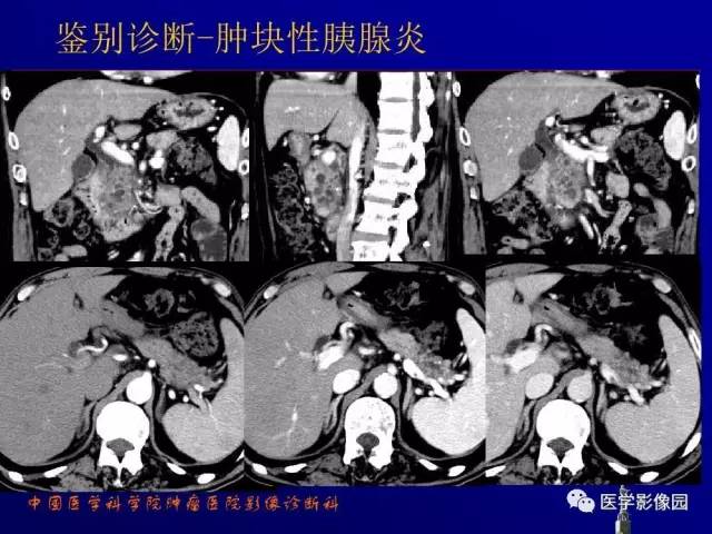 【PPT】胰腺及胆道肿瘤的CT、MRI诊断思路