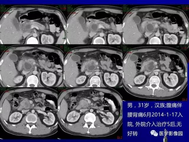 【PPT】胰腺及胆道肿瘤的CT、MRI诊断思路