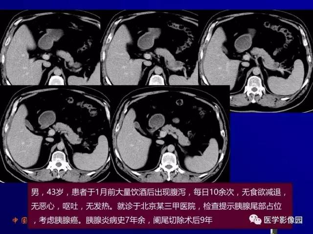 【PPT】胰腺及胆道肿瘤的CT、MRI诊断思路