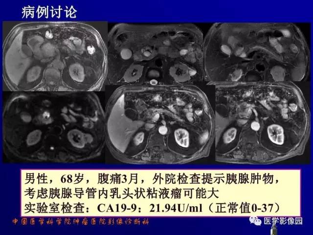 【PPT】胰腺及胆道肿瘤的CT、MRI诊断思路