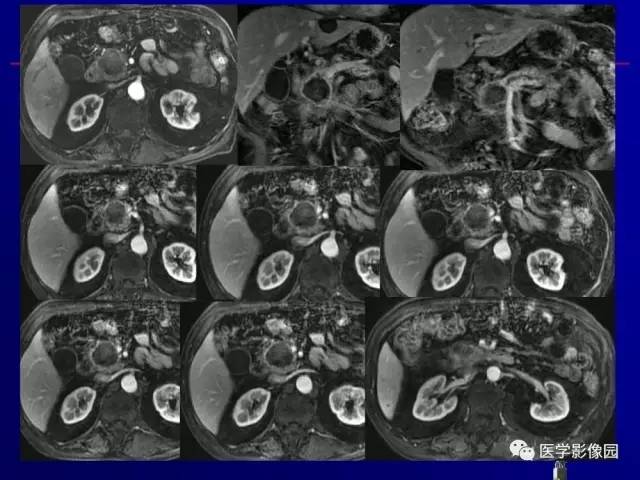【PPT】胰腺及胆道肿瘤的CT、MRI诊断思路