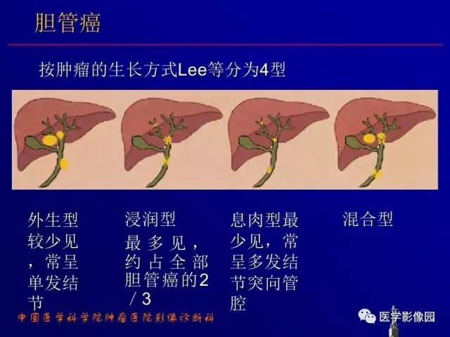 【PPT】胰腺及胆道肿瘤的CT、MRI诊断思路