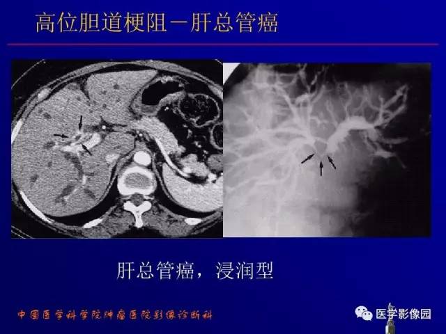 【PPT】胰腺及胆道肿瘤的CT、MRI诊断思路
