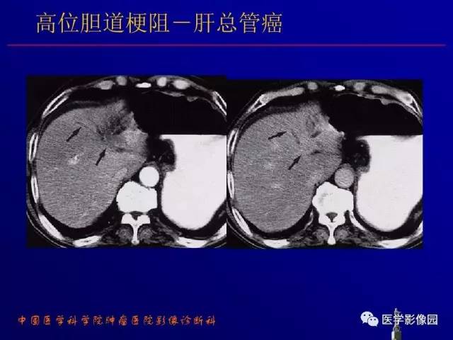 【PPT】胰腺及胆道肿瘤的CT、MRI诊断思路