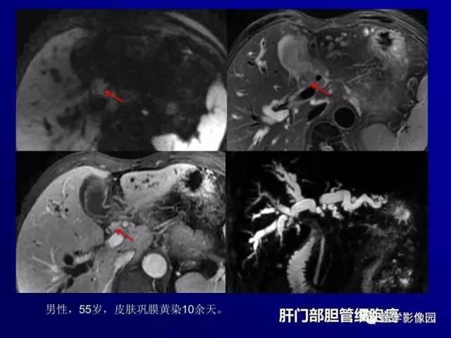 【PPT】胰腺及胆道肿瘤的CT、MRI诊断思路