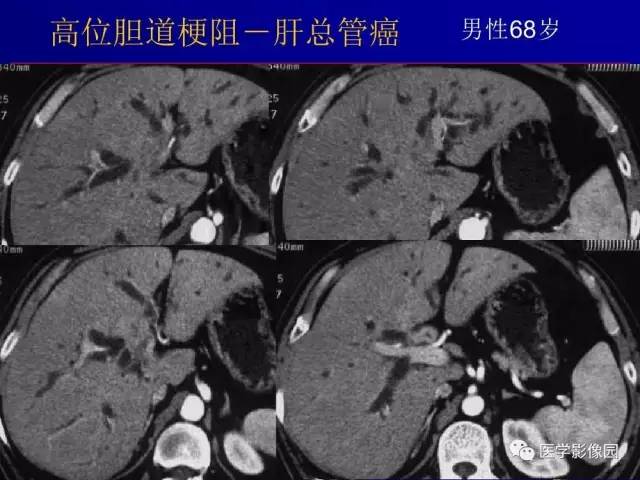 【PPT】胰腺及胆道肿瘤的CT、MRI诊断思路