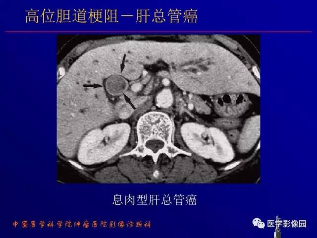 【PPT】胰腺及胆道肿瘤的CT、MRI诊断思路
