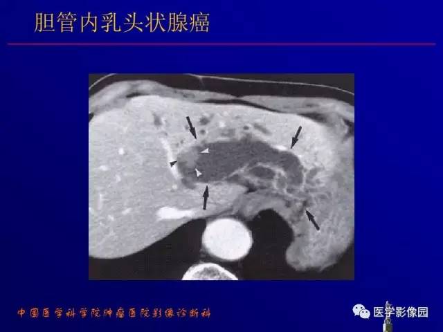 【PPT】胰腺及胆道肿瘤的CT、MRI诊断思路