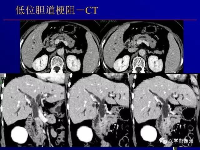 【PPT】胰腺及胆道肿瘤的CT、MRI诊断思路
