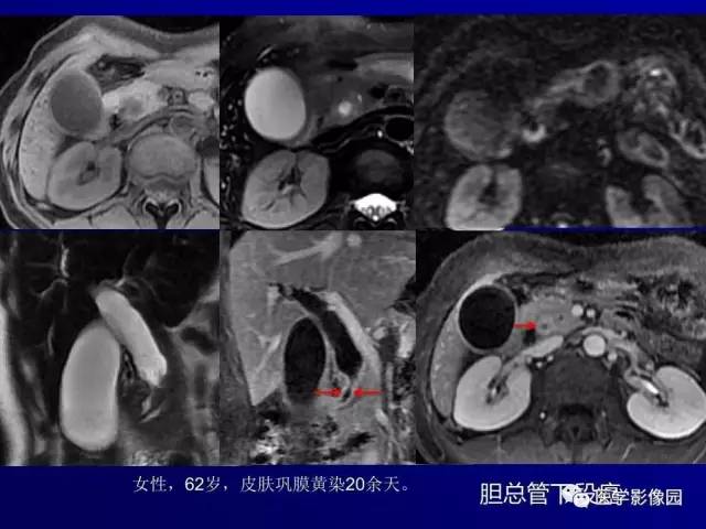 【PPT】胰腺及胆道肿瘤的CT、MRI诊断思路