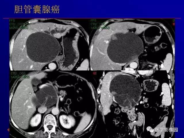 【PPT】胰腺及胆道肿瘤的CT、MRI诊断思路
