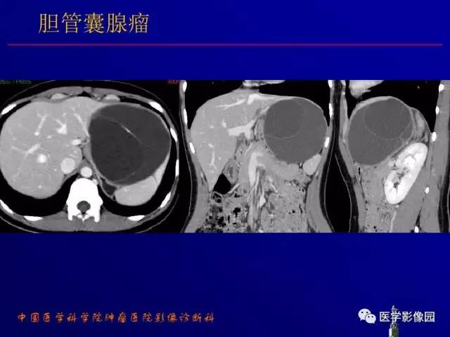 【PPT】胰腺及胆道肿瘤的CT、MRI诊断思路