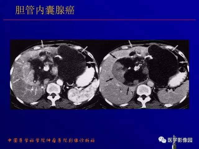 【PPT】胰腺及胆道肿瘤的CT、MRI诊断思路
