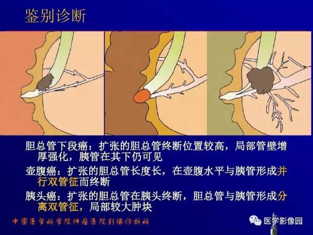 【PPT】胰腺及胆道肿瘤的CT、MRI诊断思路
